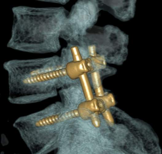 L4/5 lumbar instrumented fusion with pedicle screws